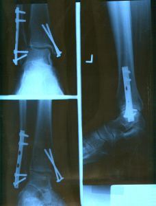 124731_ankle_x-ray.jpg