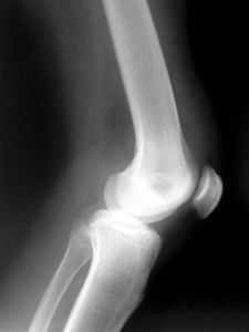 X-ray image of a human knee