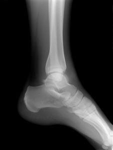 983698_ankle_x-ray.jpg
